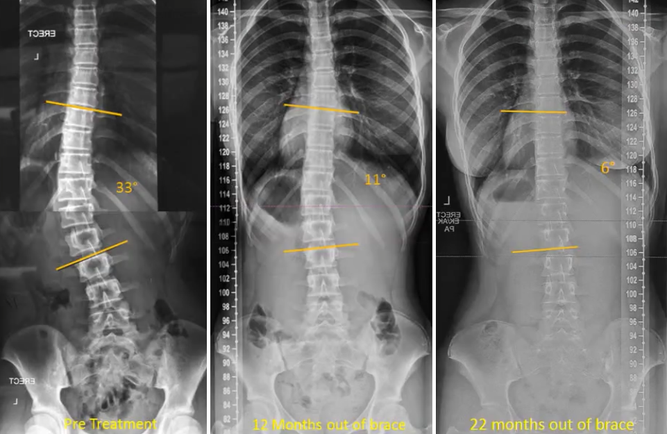 Scoliosis Braces: Can Scoliosis be Corrected with a Brace? - Turan&Turan
