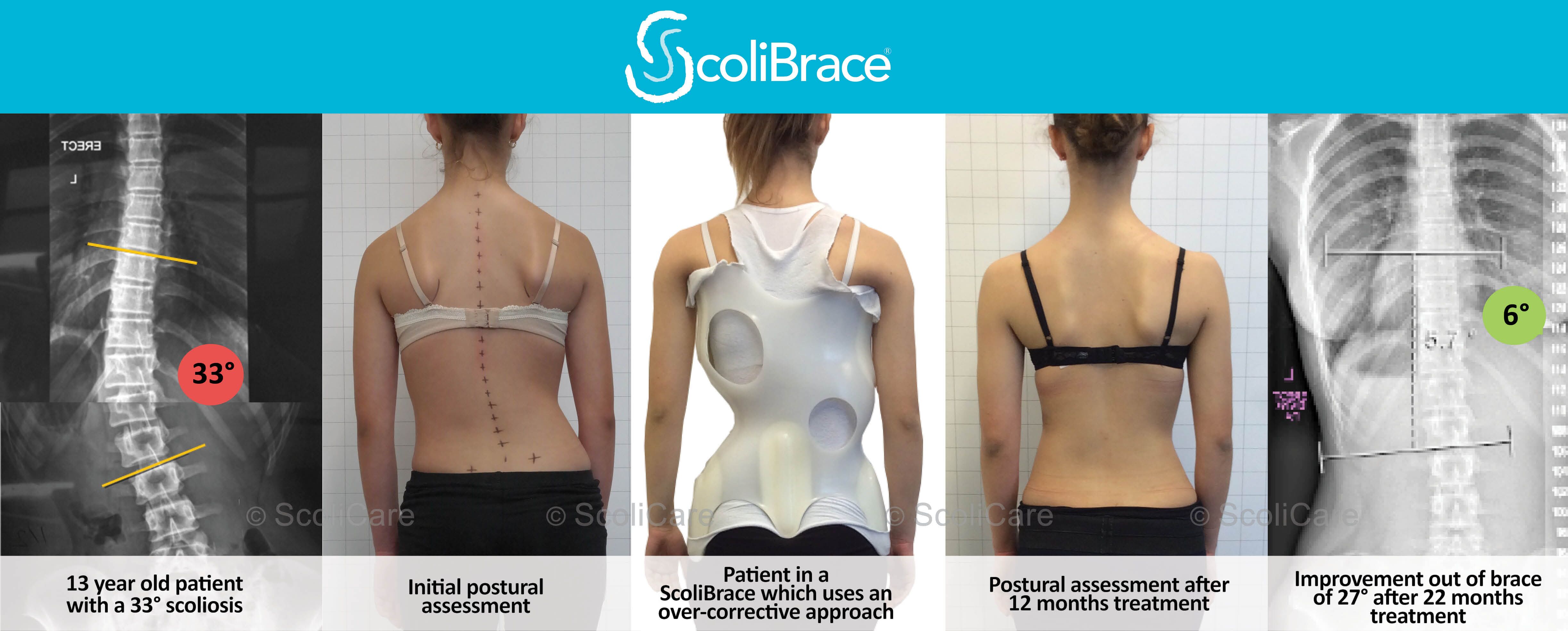 scoliosis brace