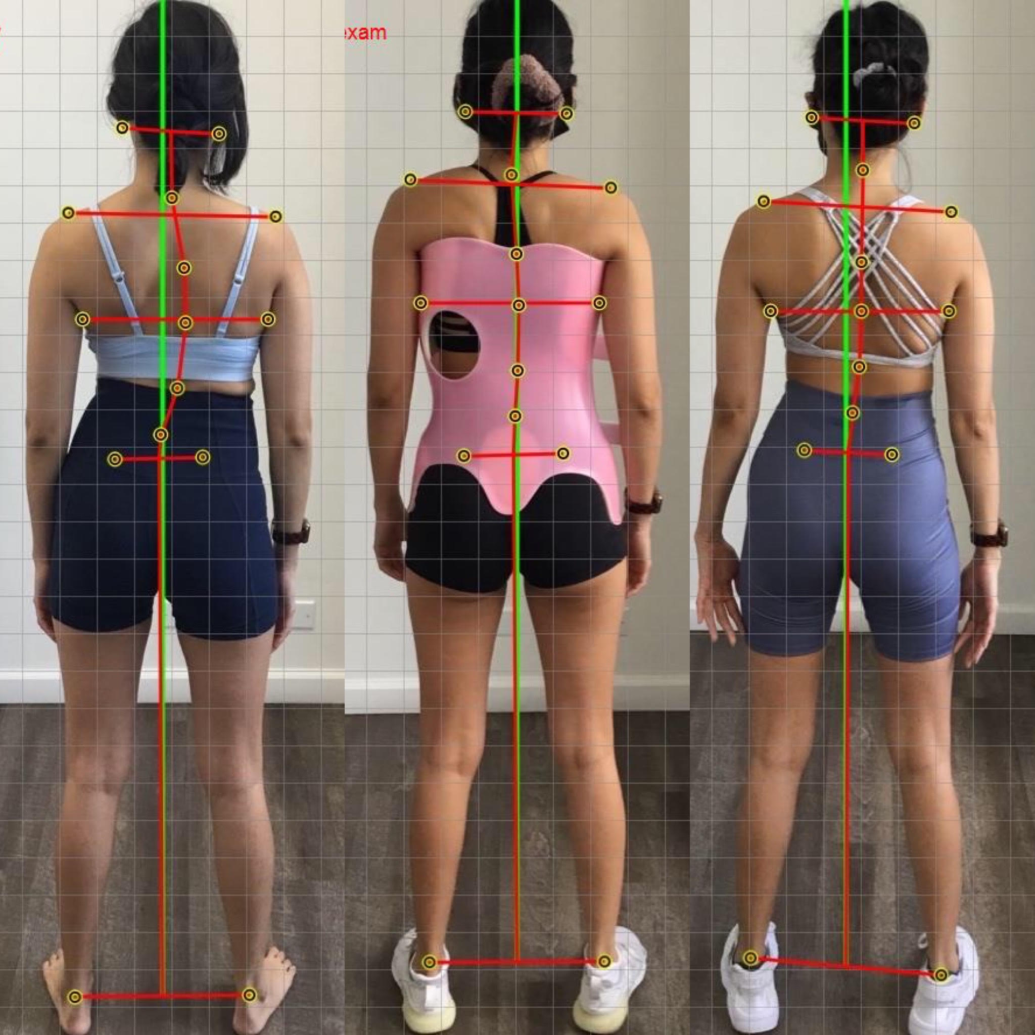 Scoliosis Awareness is More than Just the Cobb Angle - Foundation Spine ...